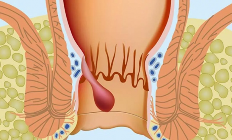 Basur (Hemoroid) İçin Hangi Doktora Gidilmelidir?
