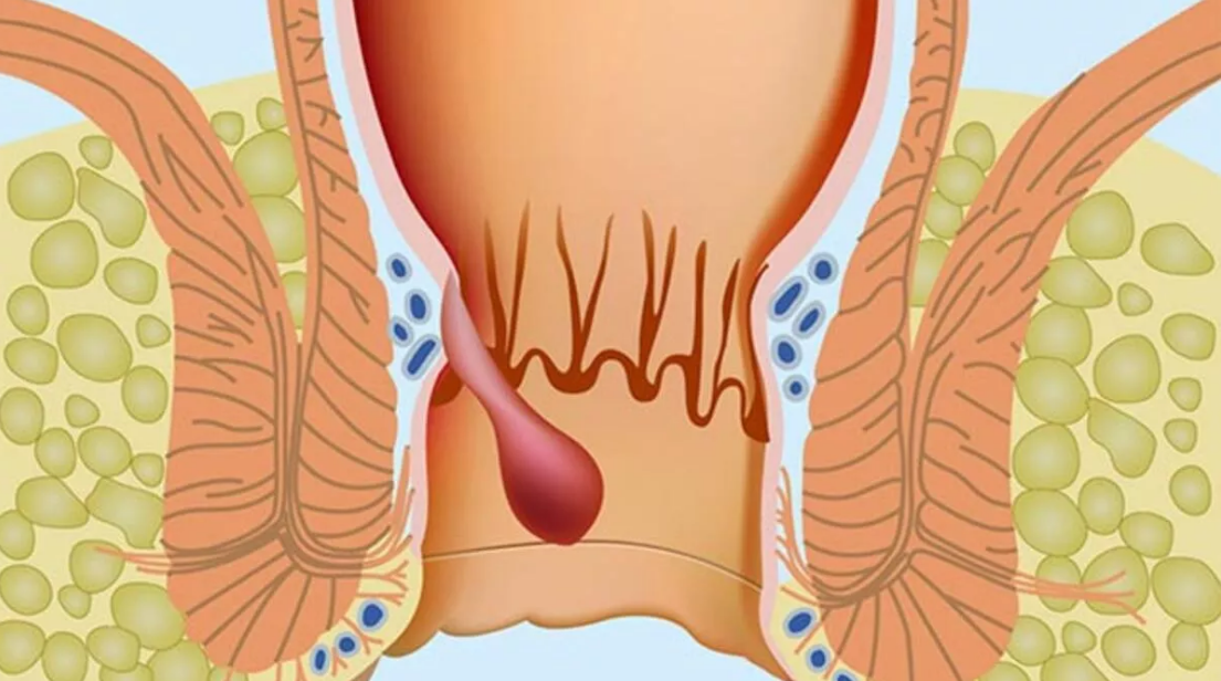 Basur (Hemoroid) İçin Hangi Doktora Gidilmelidir?